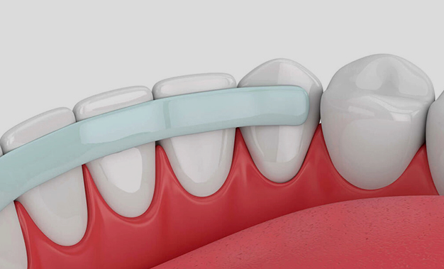 Dental crowns illustration showing tooth-colored caps covering natural teeth on red gum tissue model.