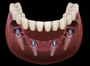 3D dental implant model showing prosthetic teeth and implant fixtures in jawbone.