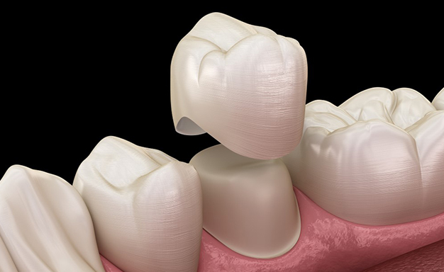 Dental crowns displayed on pink gum model showing tooth restoration procedure.