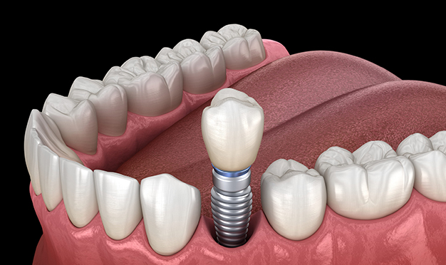 Dental implant diagram showing titanium post placement in jawbone with crown and surrounding teeth.