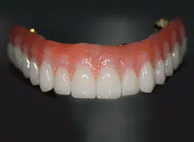 Dental prosthetic model showing full upper arch denture with pink gum base and white artificial teeth.