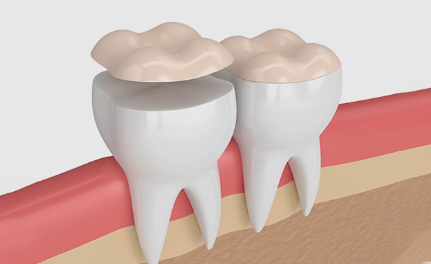 Two dental crowns illustrated on adjacent teeth within gum tissue and jawbone cross-section.