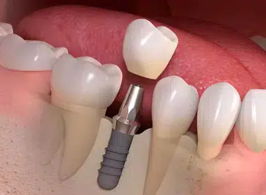 Dental implant model showing tooth restoration process with crown and implant fixture on pink gum model.