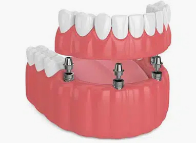 Dental implant model showing prosthetic teeth attached to implant fixtures in pink gum tissue.